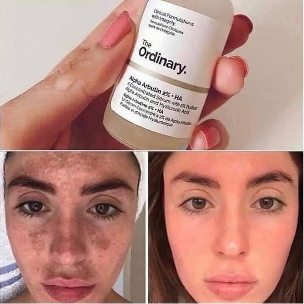The Ordinary Alpha Arbutin 2% + HA Hyperpigmentation Serum trắng da, mờ thâm 30mil TOTO shop