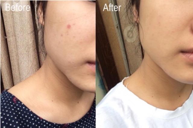 Tinh Chất Mờ Thâm Mụn Rohto Melano CC Vitamin C Serum