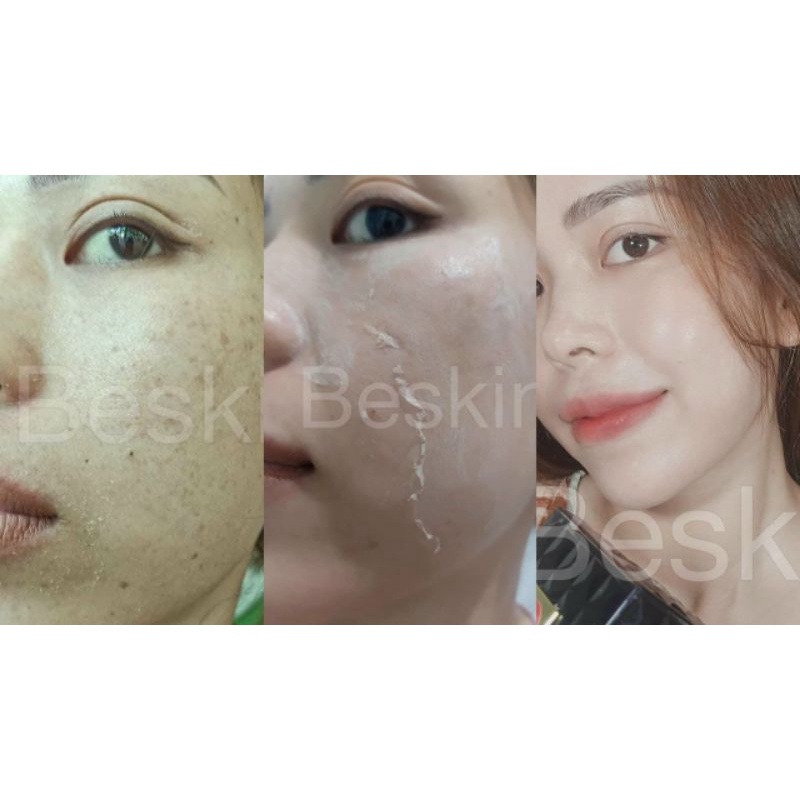 Kem face nám tàn nhang Melasma Cream