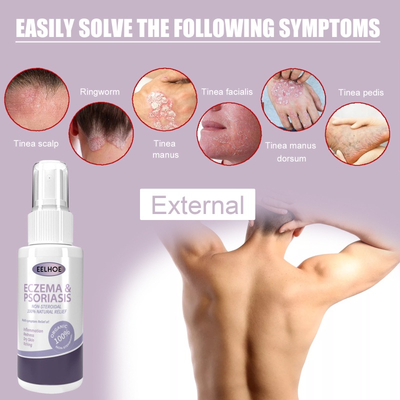EELHOE Kem Trị Bệnh Vẩy Nến Da   Mỡ Điều Trị Bệnh Vẩy Nến Viêm Da Eczematoid Skin-Ampere