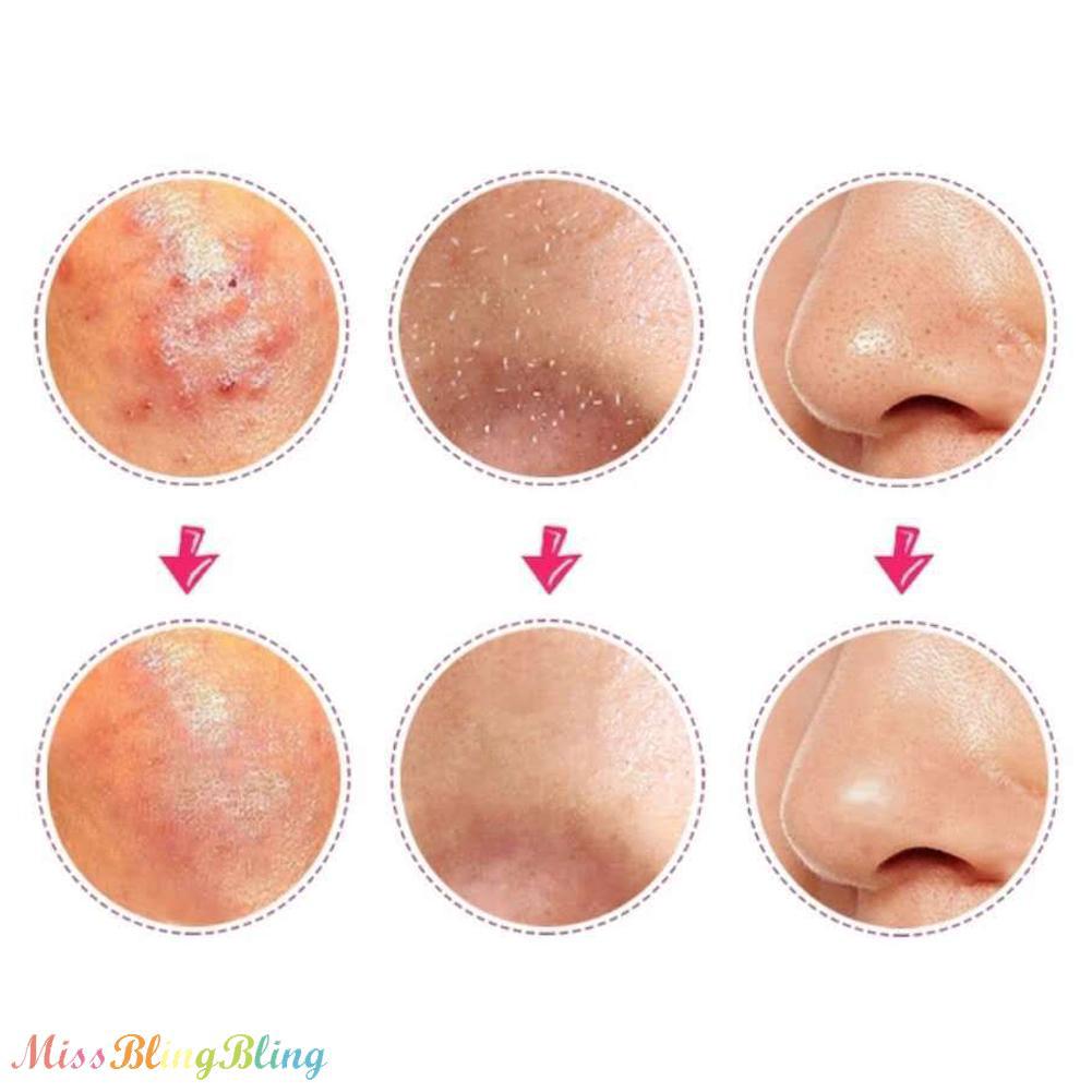 Dụng Cụ Nặn Mụn Đầu Đen