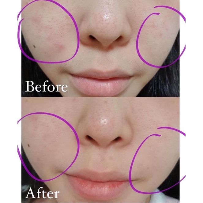 [FREE SHIP] Kem Dưỡng Giảm Mụn Ẩn Mịn da