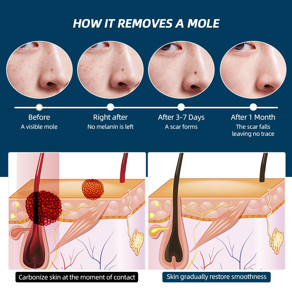 Foreverlily Bút Laser Xóa Tàn Nhang Đốm Đen Trên Da Mặt bút loại bỏ nốt ruồi