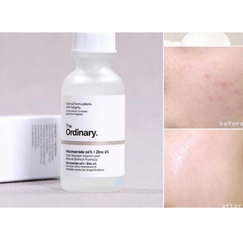 Tinh chất Serum The Ordinary Niacinamide 10% + Zinc 1% giảm mụn, thu nhỏ lỗ chân lông