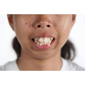 Niềng răng màu trắng tại nhà an toàn hiệu quả toàn màu trắng khách nhé BbR012