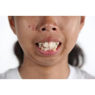 NIỀNG RĂNG an toàn silicon