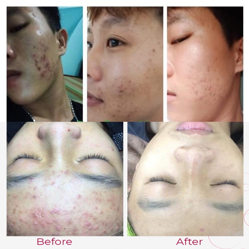 Viên uống giảm mụn Biotrade Acnaut Food Supplement 30 viên, đẹp da, giảm thâm mụn  - Dr. Thu Hà