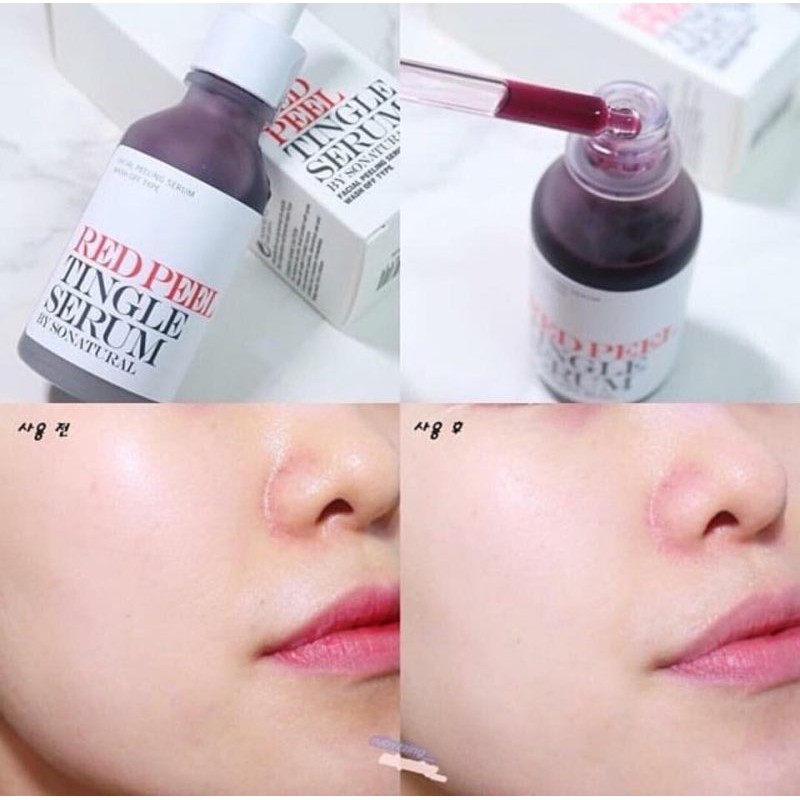 [GIÁ HỦY DIỆT] [30ML] Red Peel Tingle Serum Ngừa Mụn AHA BHA So Natural Hàn Quốc