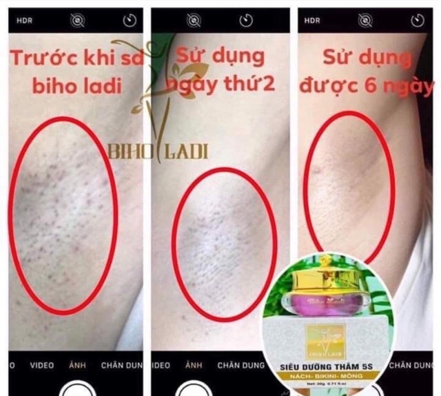 BIHO LADY 5S - SIÊU DƯỠNG THÂM 5S ( Có Sẵn) | BigBuy360 - bigbuy360.vn