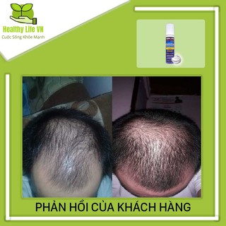 Minoxidil 5% Dạng Bọt Mọc Râu Tóc Kirkland Mỹ