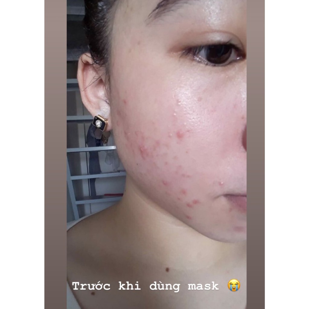 ( TOP SẢN PHẨM KIỂM SOÁT MỤN ) MẶT NẠ ĐẨY MỤN HIMALAYA Handmade | BigBuy360 - bigbuy360.vn