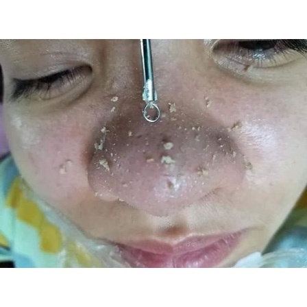 Tinh Chất Ủ Mụn Youngerc 30ml Hàng Chuẩn Ủ Mụn Đầu Đen, Mụn Cám, Sợi Bã Nhờn