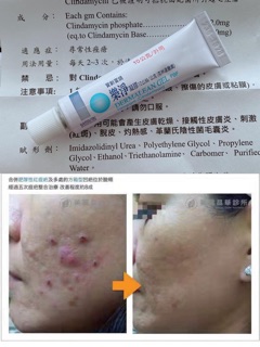 Gel bôi mụn trong suốt