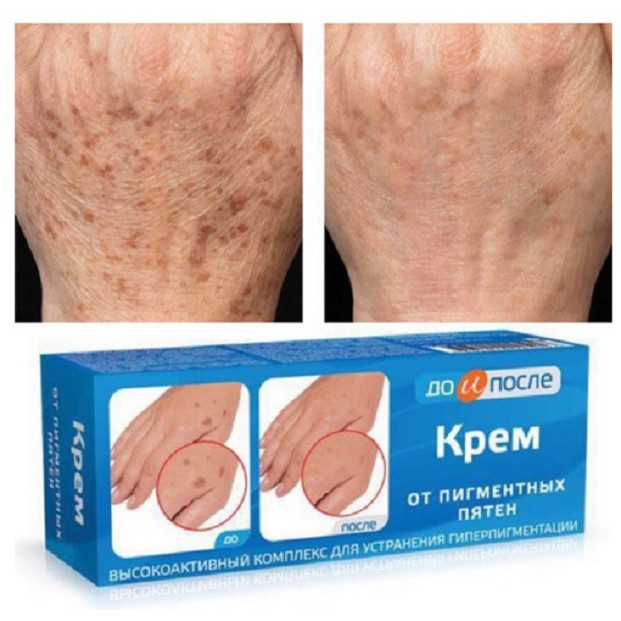 Kem ngừa, giảm Đồi Mồi Đốm Nâu Da Tay Kpem Hàng Nga