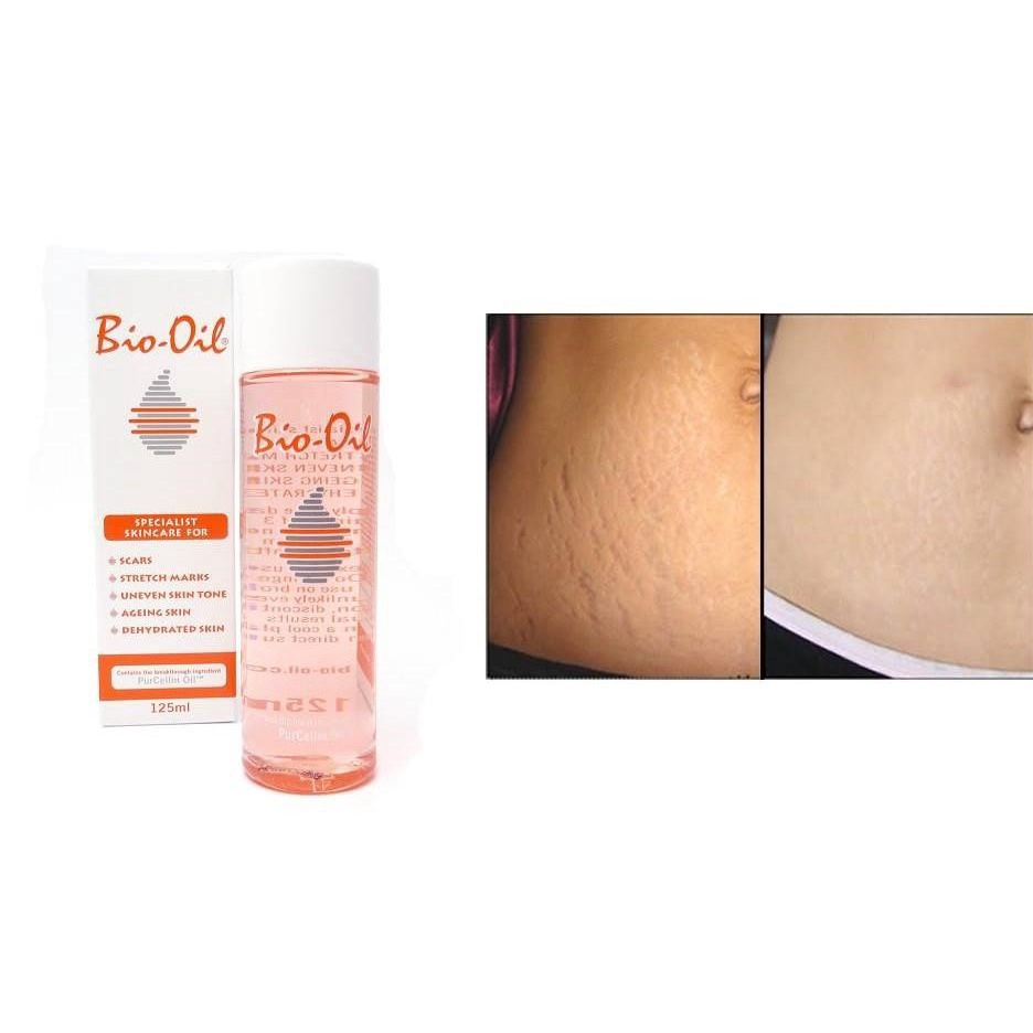 Tinh Dầu Bio-Oil Scar Treatment-125ml. Dành cho người mang thai- Cam kết hết Rạn Da làm Mờ Sẹo sau 1 liệu trình 3 hộp.