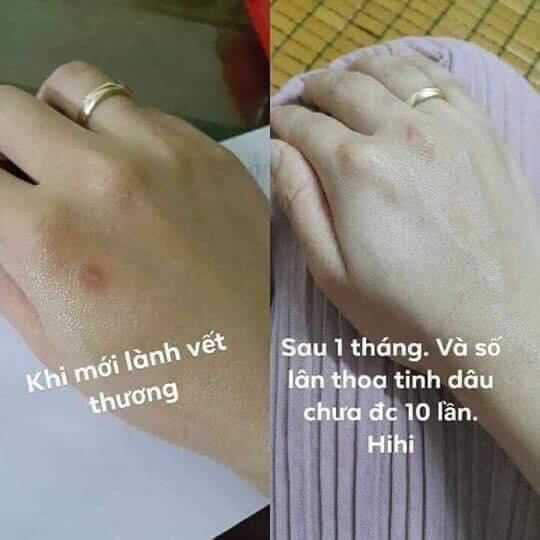 Xoá Thâm Mụn-Thâm Côn Trùng- Thâm Môi-Thâm Mắt-Thâm Nách...Ngọc Thiên Hương