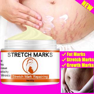 [Hàng mới về] Kem Loại Bỏ Rạn Da Sau Sinh Hiệu Quả Chất Lượng Cao