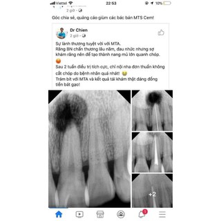 Hàn ống tủy mta crems 1.5g