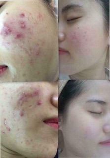 Bộ lăn kim tay #ZGTS 540