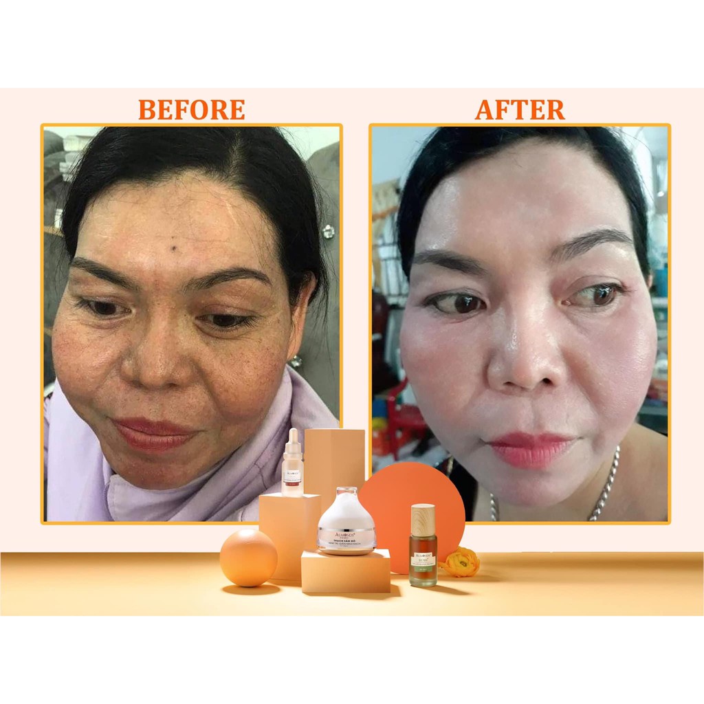 Dung dịch Hemo đào thải corticoid cho da giãn mao mạch, nám máu Almonds