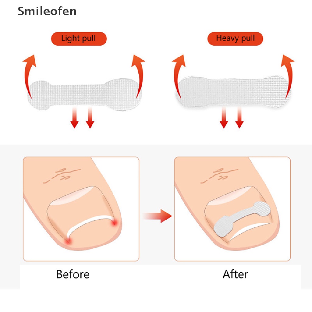 Set 10 Miếng Dán Chỉnh Sửa Móng Chân Mọc Ngược