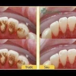 BỘT THAN TRE HOẠT TÍNH TRĂNG RĂNG ZENPALI ( Tặng 1tuyp kem đánh răng SENSODYNE )