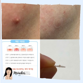 Miếng dán mụn nội địa Hàn Comet Band