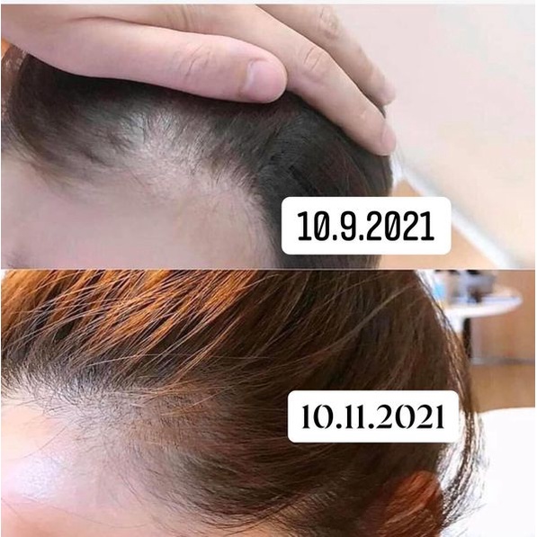 Bôi mọc tóc, giảm rụng tóc nấm hói đầu 30ml hàng Nhật