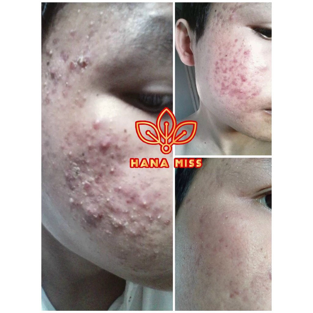 Serum mụn Hana Miss ⚡100% KHỎI MỤN⚡ xóa thâm sạm nám tái tạo da | BigBuy360 - bigbuy360.vn