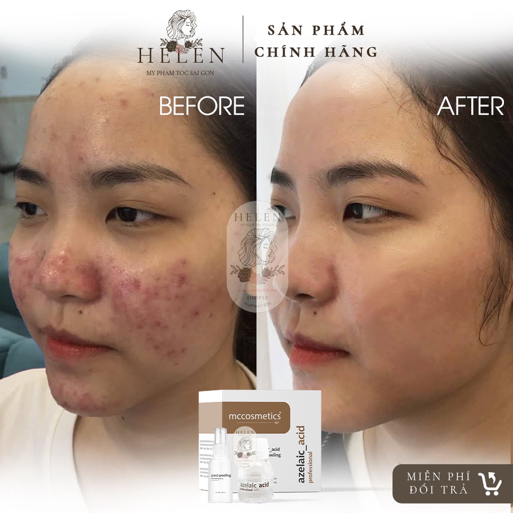 Peel AZELAIC MCCM & MCCOSMETIC-Dành cho mụn viêm, trứng cá đỏ và da nhạy cảm