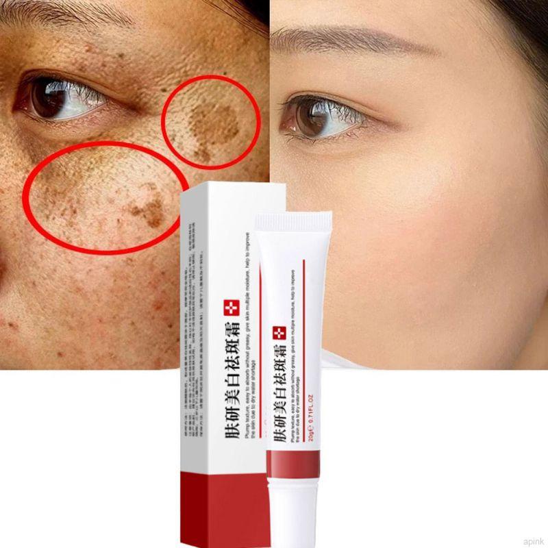 Kem Hỗ trợ giảm tàn nhang 20g Giúp Dưỡng Ẩm Và Làm Trắng Da Hiệu Quả