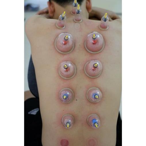 Bộ giác hơi hút chân không 32 cốc  - SPAMALL