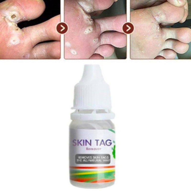 Skin Tag Remover 12 Hours Tu Kill Tu Kill Remover Skin Tag Mole & Genital Wart Remover Foot Corn Removal 10Ml