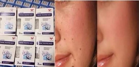 Tẩy mục ruồi Nga