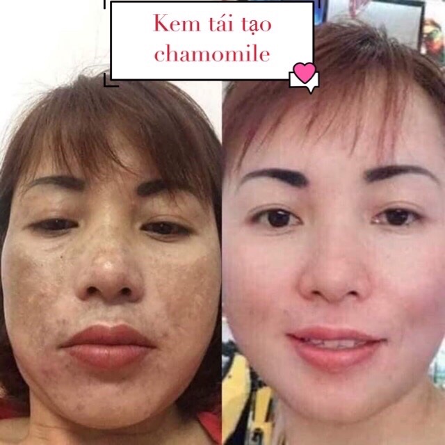 Combo Kem tái tạo + Hồng Sâm chamomile