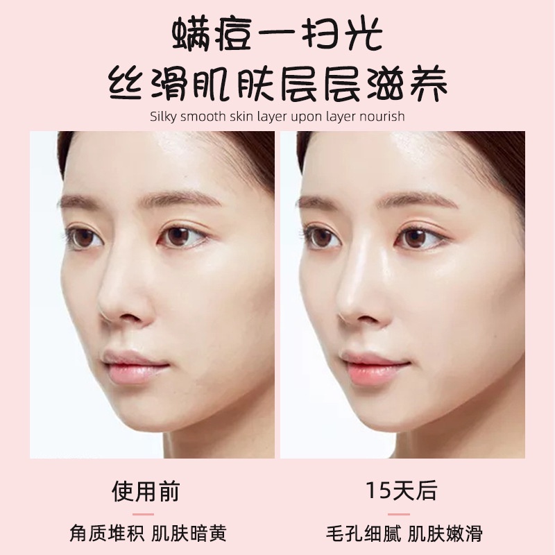 [Hàng mới về] Xà phòng hỗ trợ giảm mụn đầu đen kiềm dầu hiệu quả