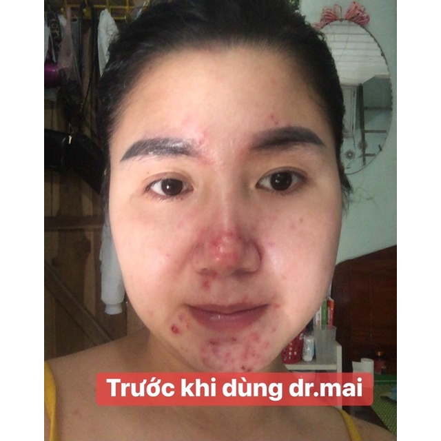 Tinh Chất Giảm Mụn Mờ Thâm - Dr Mai Nguyên Chất và Mix Saffron 6ml