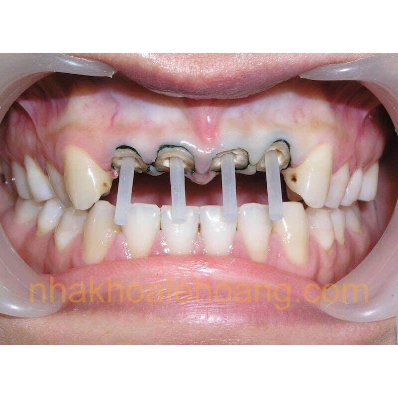 Chốt sợi thạch anh,vật liệu nha khoa hộp chốt 20 cái