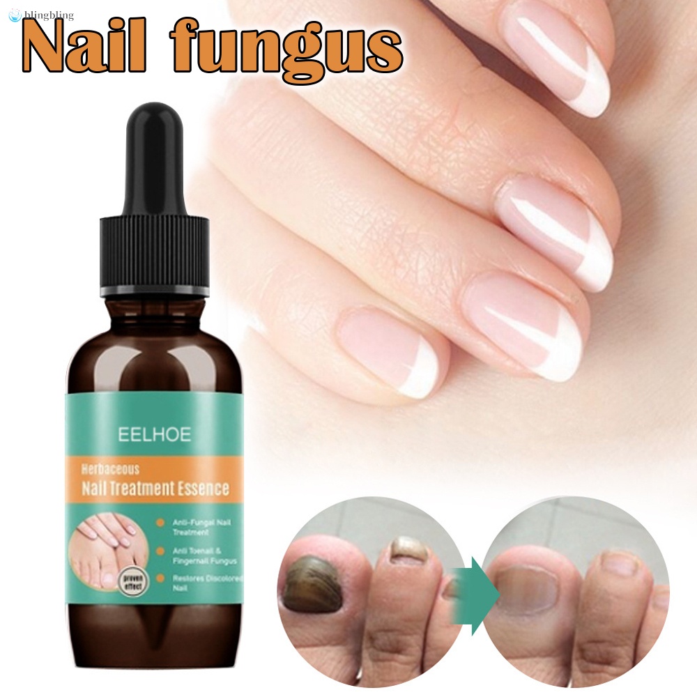 Tinh Chất Hỗ Trợ Giảm Bệnh Nấm Móng Tay Móng Chân Dung Tích 10ml 30ml