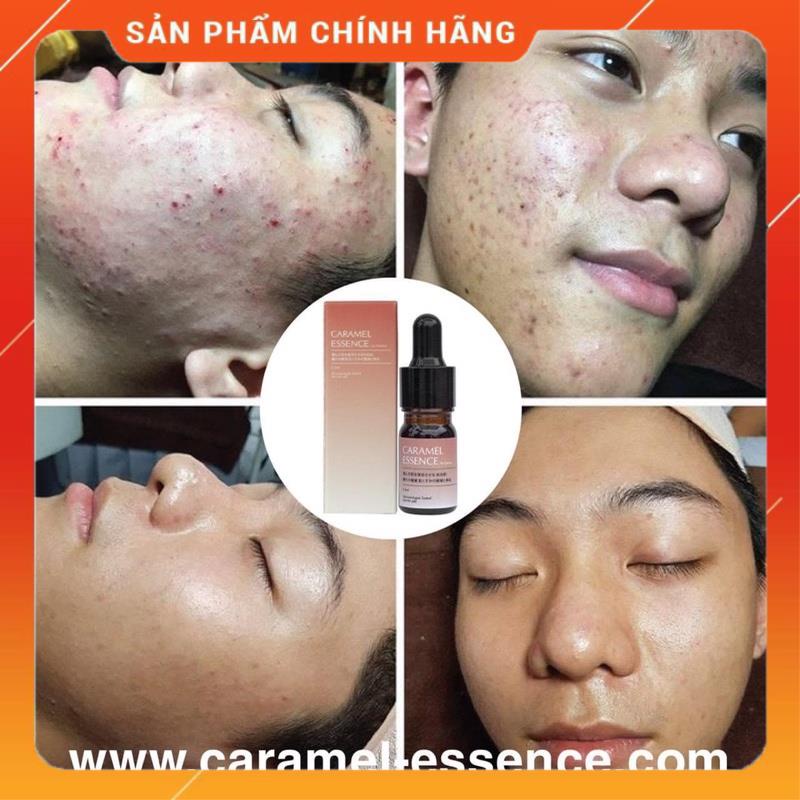 Serum CARAMEL ESENCE Ngừa Mụn Xoá Thâm Hãng Nhật Bản