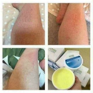Viêm nang lông. Nỗi ám ảnh của chị e phụ nữ