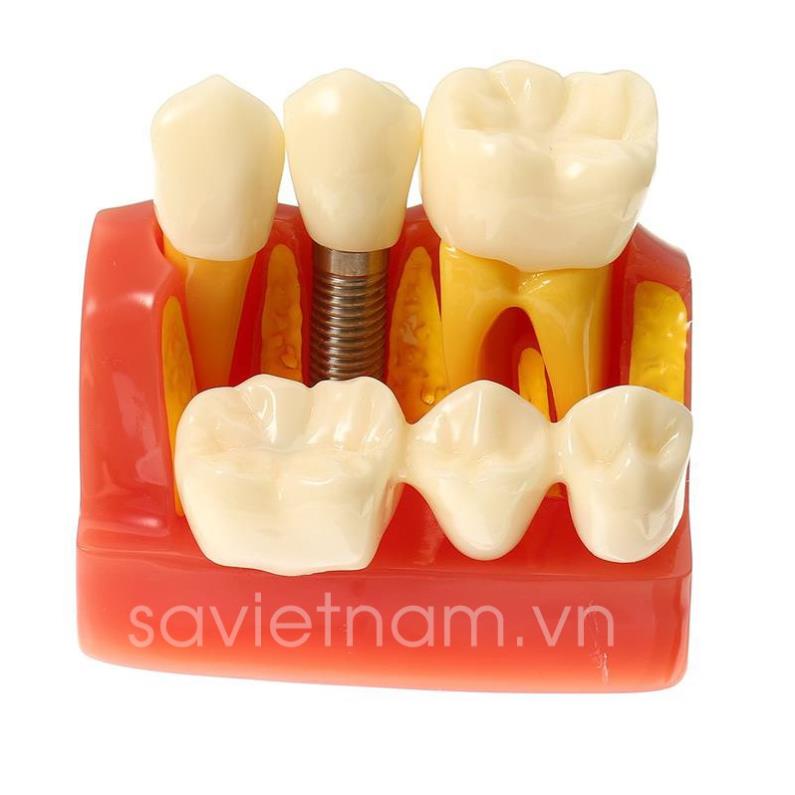 Hàm tư vấn so sánh cầu răng và implant trong Nha khoa