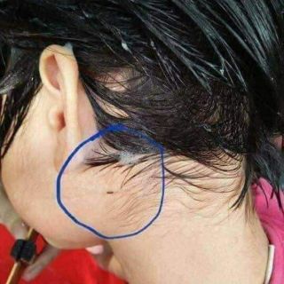 Trị chấy và trứng chấy