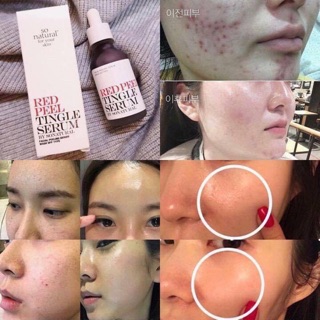 Tinh chất tái tạo da Red peel