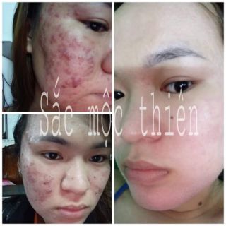 TINH CHẤT TÁI TẠO DA SẮC MỘC THIÊN