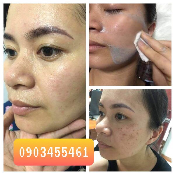 OL- CELL Kem THẢI NÁM 🌸 có hạt massage Hàn Quốc [ CÓ TEM CHỐNG GIẢ LÀ HÀNG GIẢ ] | BigBuy360 - bigbuy360.vn