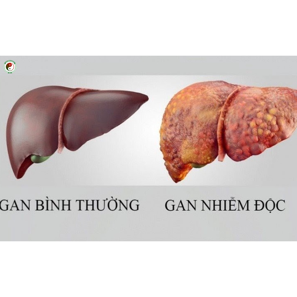 Giải Độc Gan Hạ Men Gan - Giải Độc Cơ Thể - Thải Độc Gan Nhiễm Mỡ