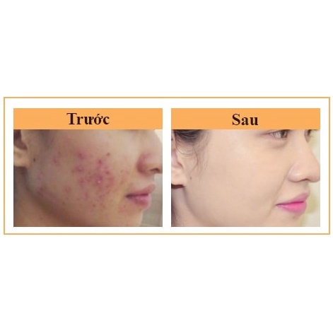 Gel Giảm Mụn Mờ Thâm Sẹo Derma Forte