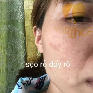 CHẤM TÀN NHANG, SẸO RỖ, MỤN RUỒI, MỤN THỊT