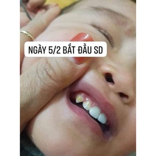 que bôi chống sâu răng vecni flour mỹ